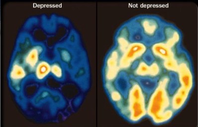 depression-brain